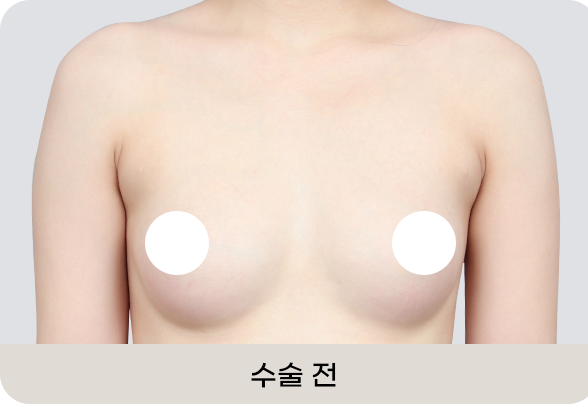 디에이 모티바 가슴성형
