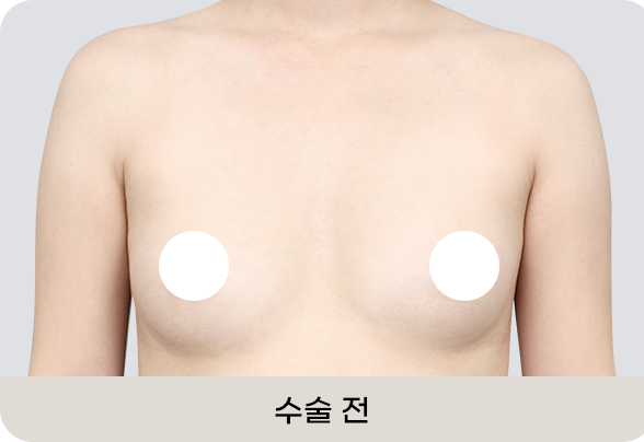 디에이 모티바 가슴성형