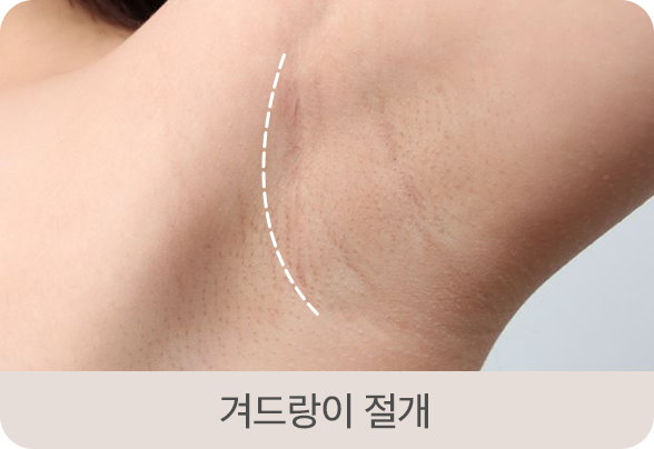디에이 모티바 가슴성형