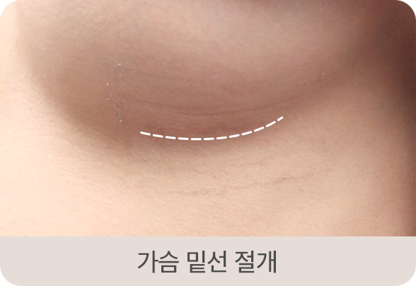 디에이 모티바 가슴성형