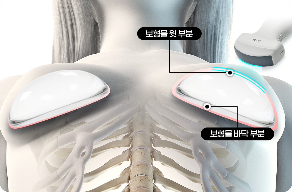 디에이 가슴 재수술