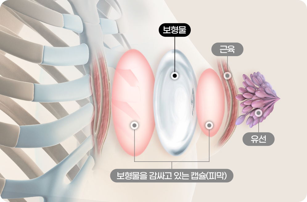 디에이 가슴 재수술