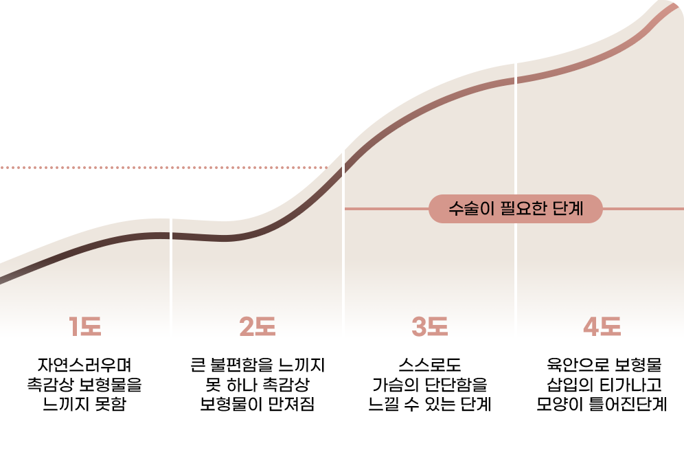 디에이 가슴 재수술