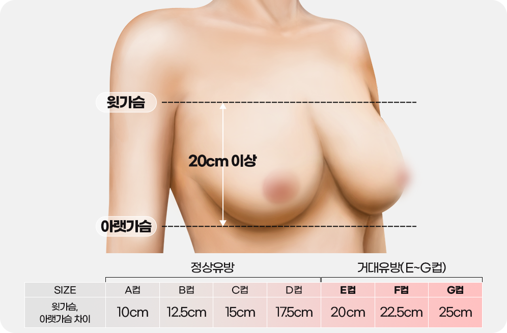 디에이 가슴 재수술