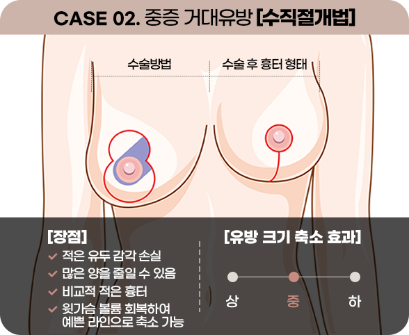 디에이 가슴 재수술