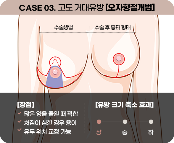 디에이 가슴 재수술