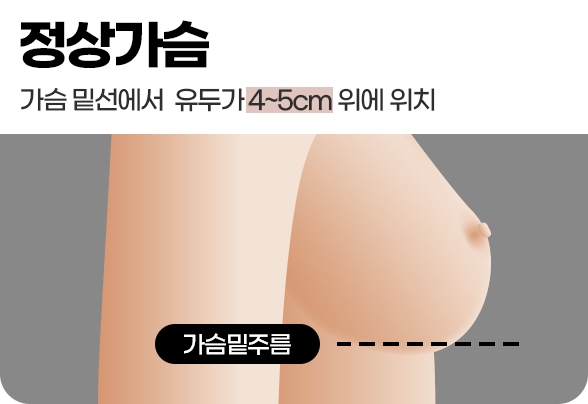 디에이 가슴 재수술