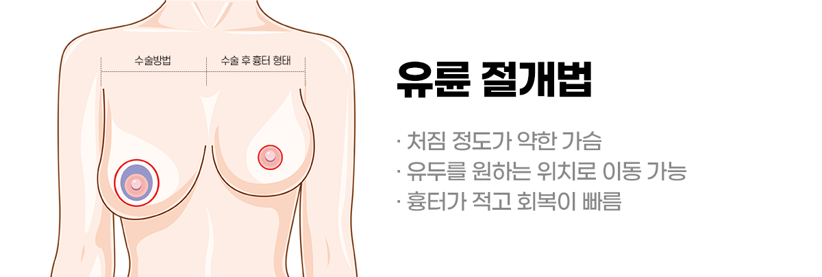 디에이 가슴 재수술