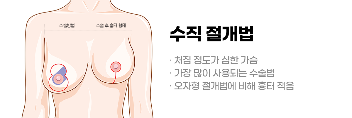 디에이 가슴 재수술