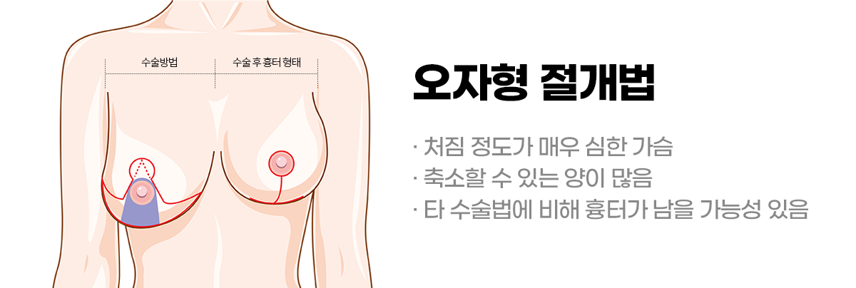 디에이 가슴 재수술