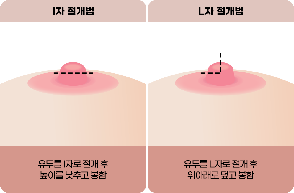 디에이 가슴 재수술