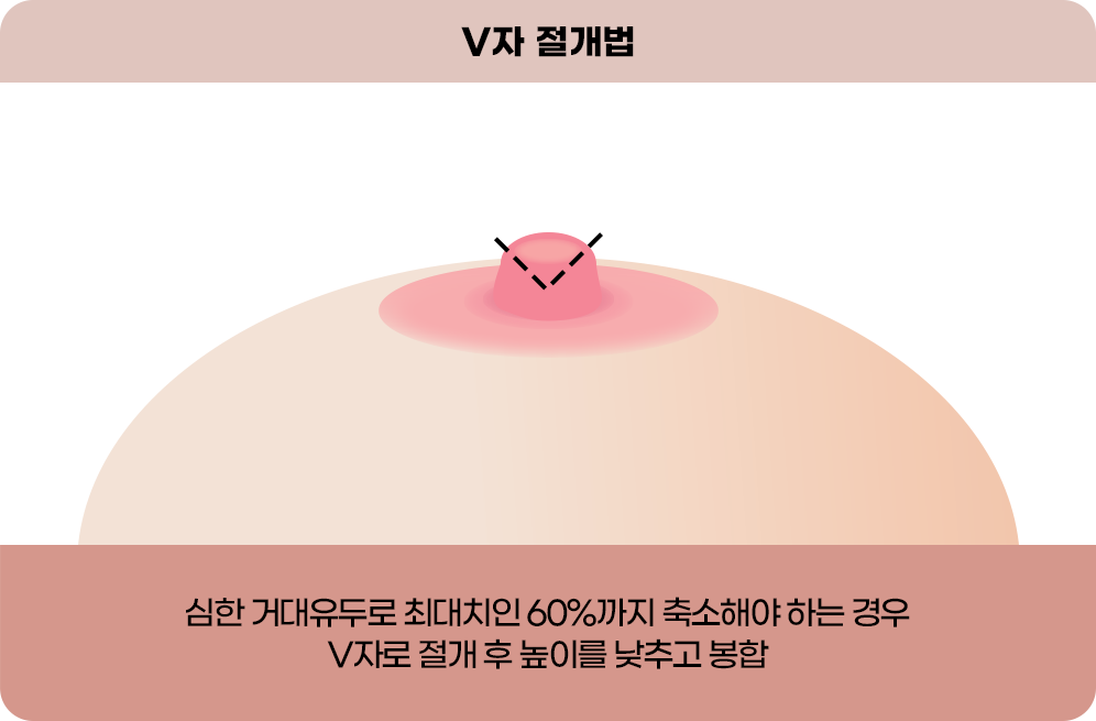 디에이 가슴 재수술