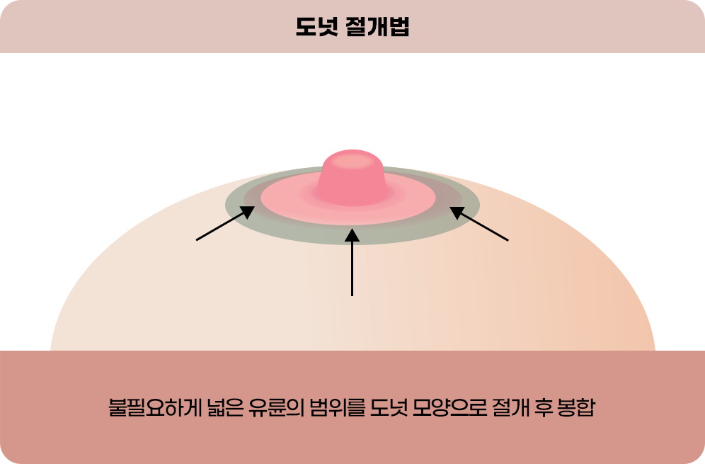 디에이 가슴 재수술