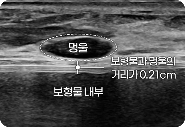 디에이 맘모톰