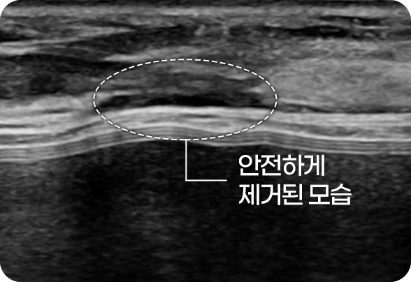 디에이 맘모톰