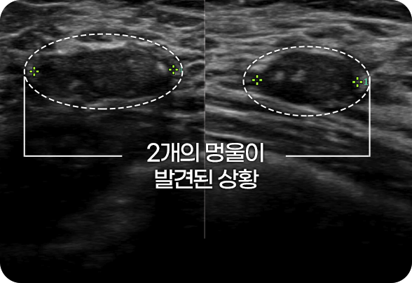 디에이 맘모톰