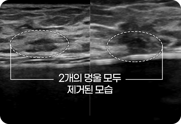 디에이 맘모톰