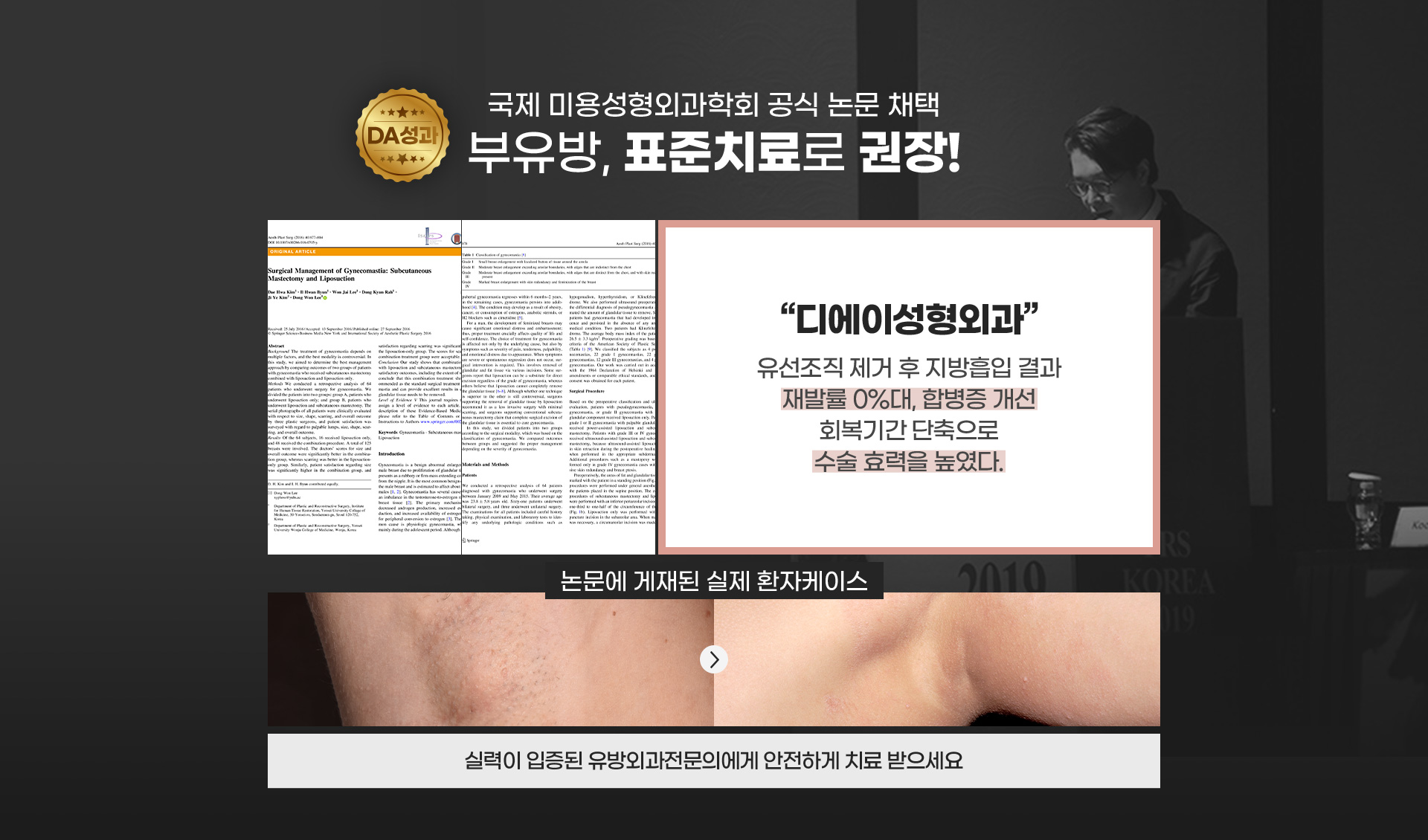 국제 미용성형외과학회 공식 논문 채택 부유방, 표준치료로 권장!