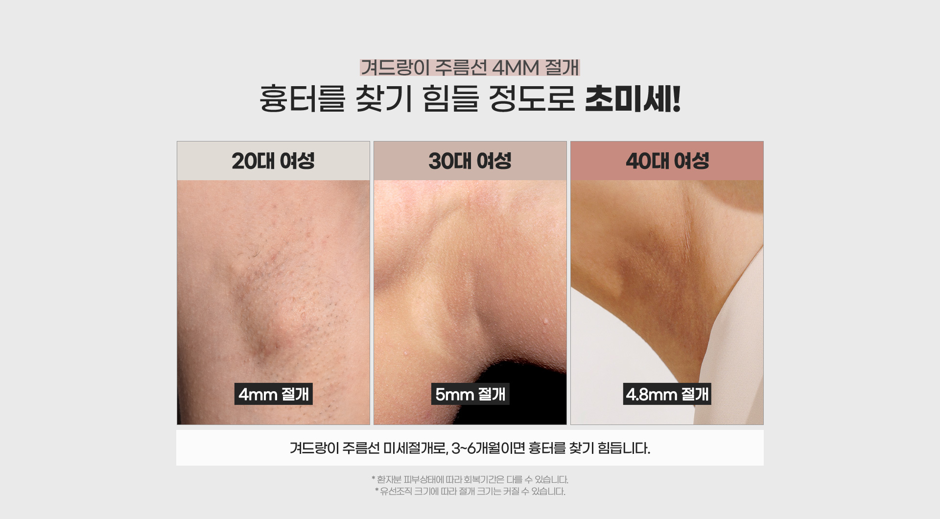 겨드랑이 주름선 4MM 절개 흉터를 찾기 힘들 정도로 초미세!