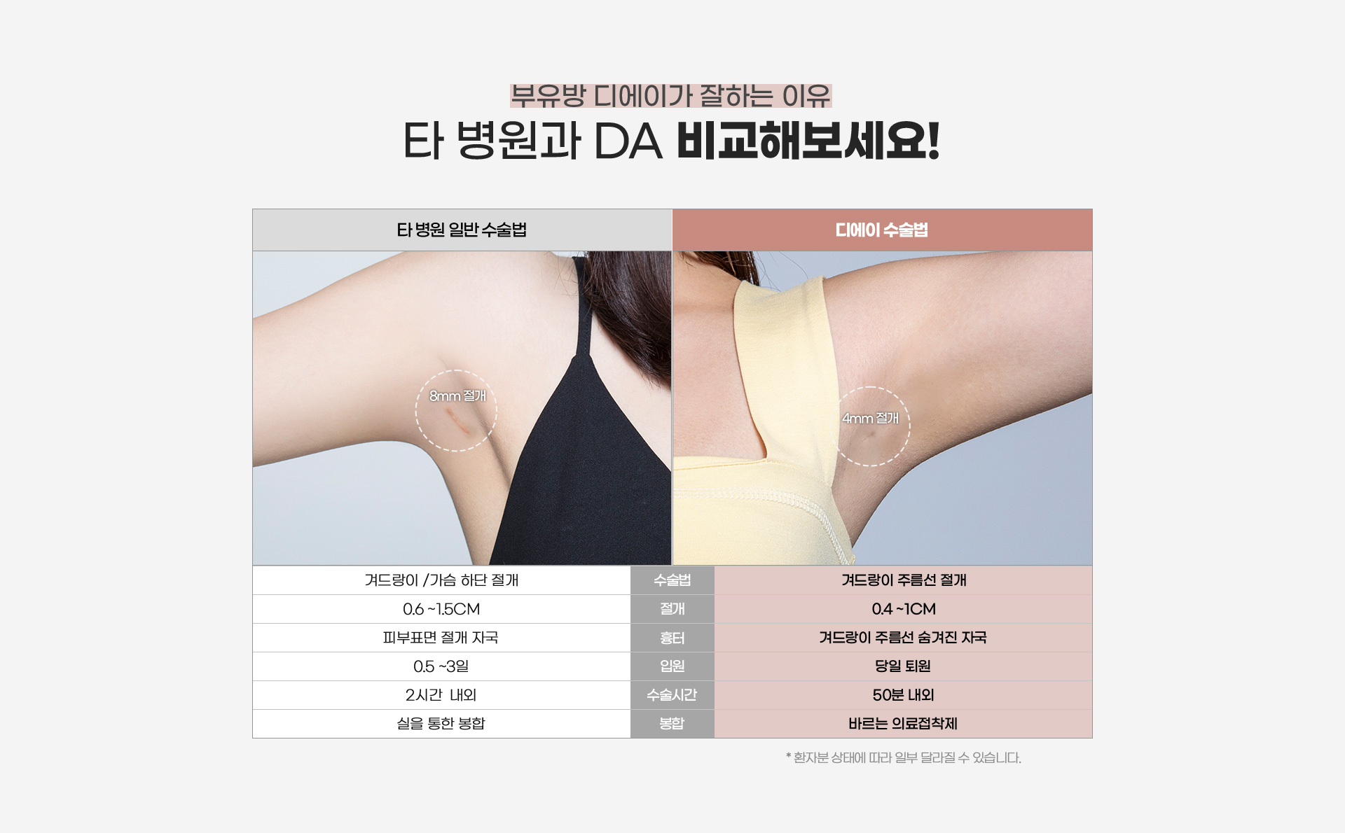 부유방 디에이가 잘하는 이유 타 병원과 Da 비교해보세요!