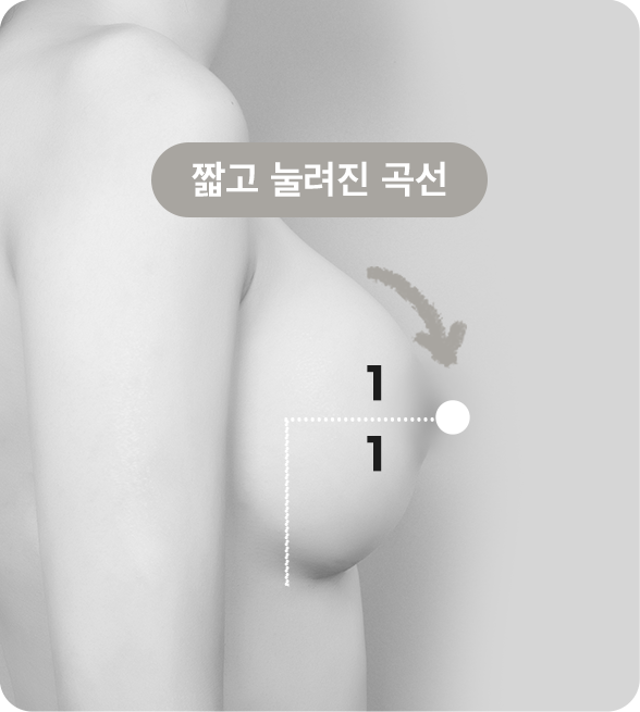 디에이 바운스 가슴성형