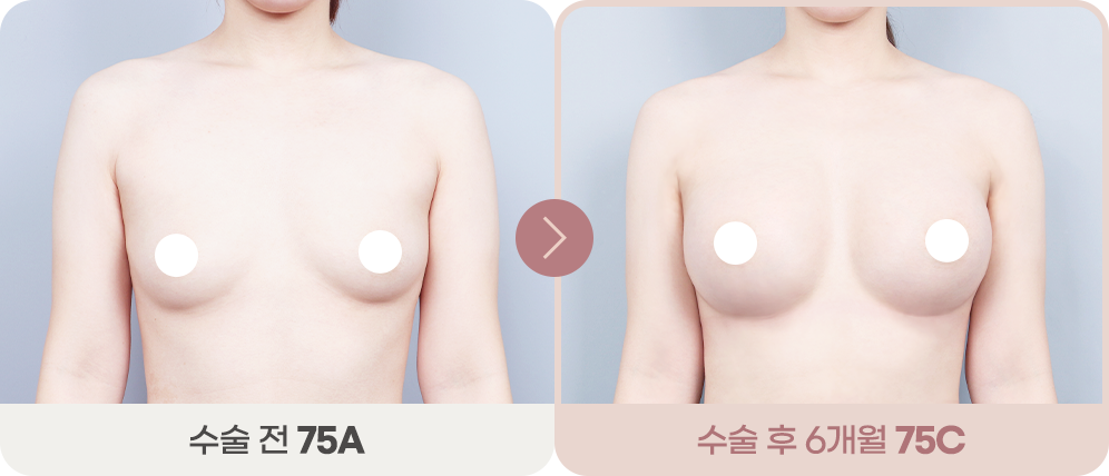 디에이 바운스 가슴성형