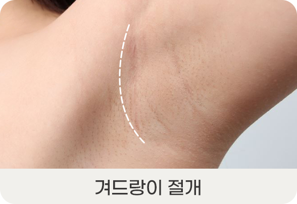디에이 I라인 가슴성형