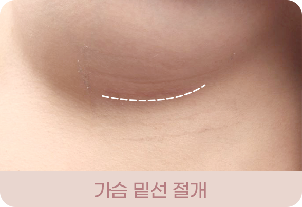 디에이 I라인 가슴성형
