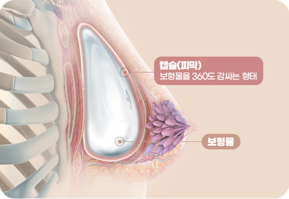 디에이 가슴재수술