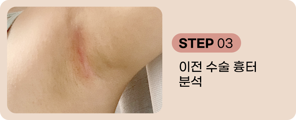 디에이 가슴 재수술