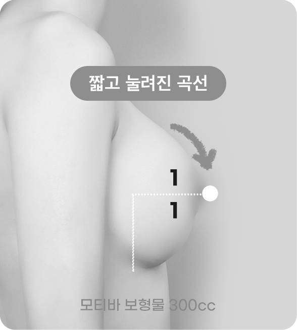 디에이 I라인 가슴성형