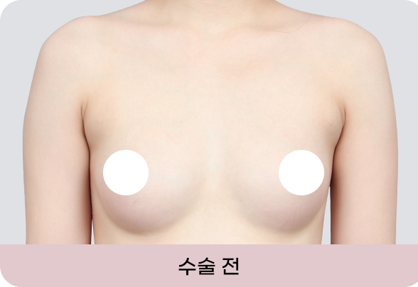 디에이 I라인 가슴성형
