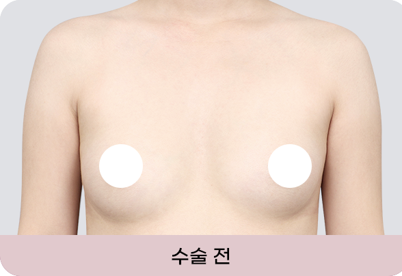 디에이 I라인 가슴성형