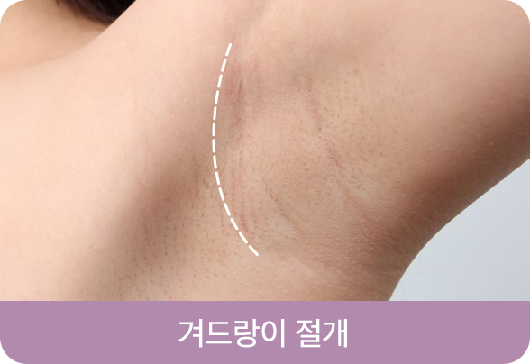 디에이 I라인 가슴성형