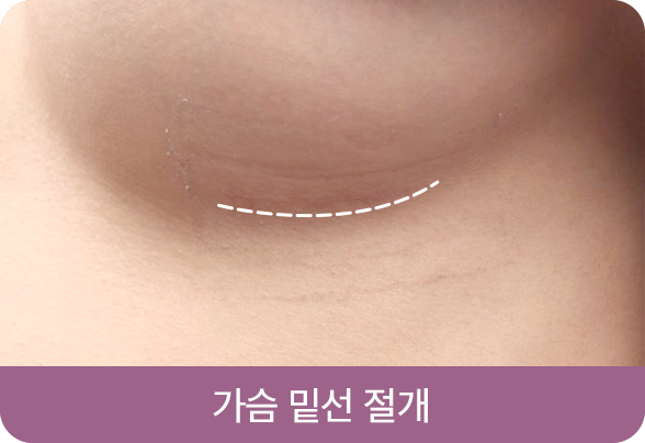 디에이 I라인 가슴성형