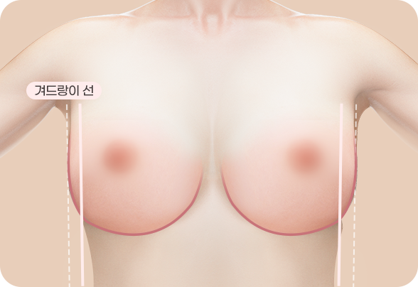 CASE 1. U LINE