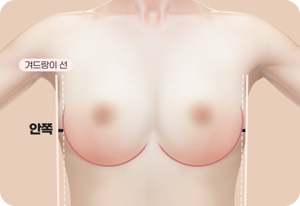 CASE 2. NARROW LINE
