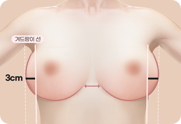 CASE 3. WIDE LINE