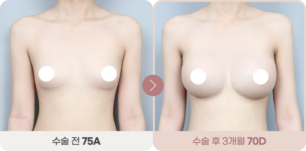 디에이 슬렌더 가슴성형 전후 1