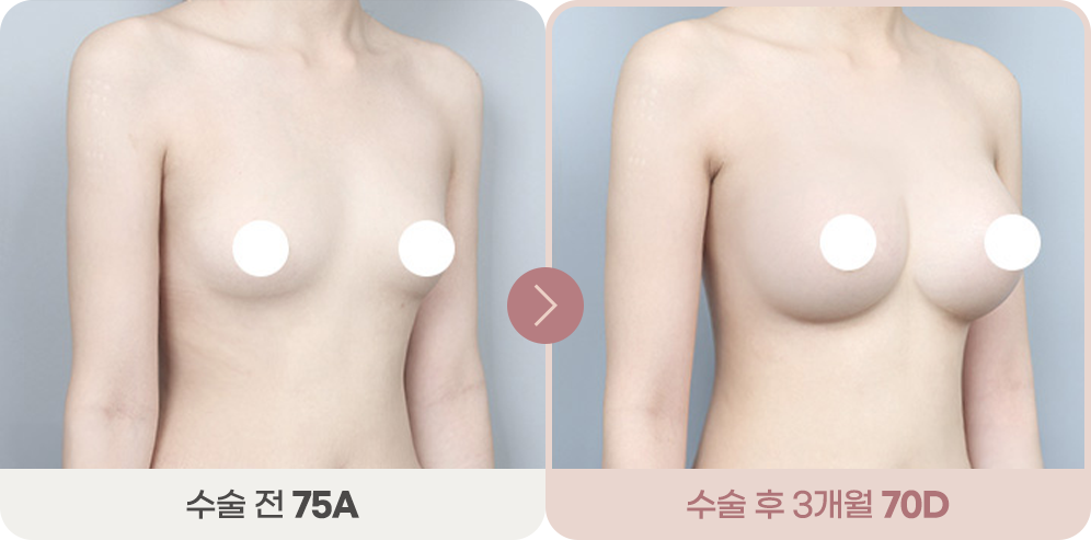디에이 슬렌더 가슴성형 전후 2