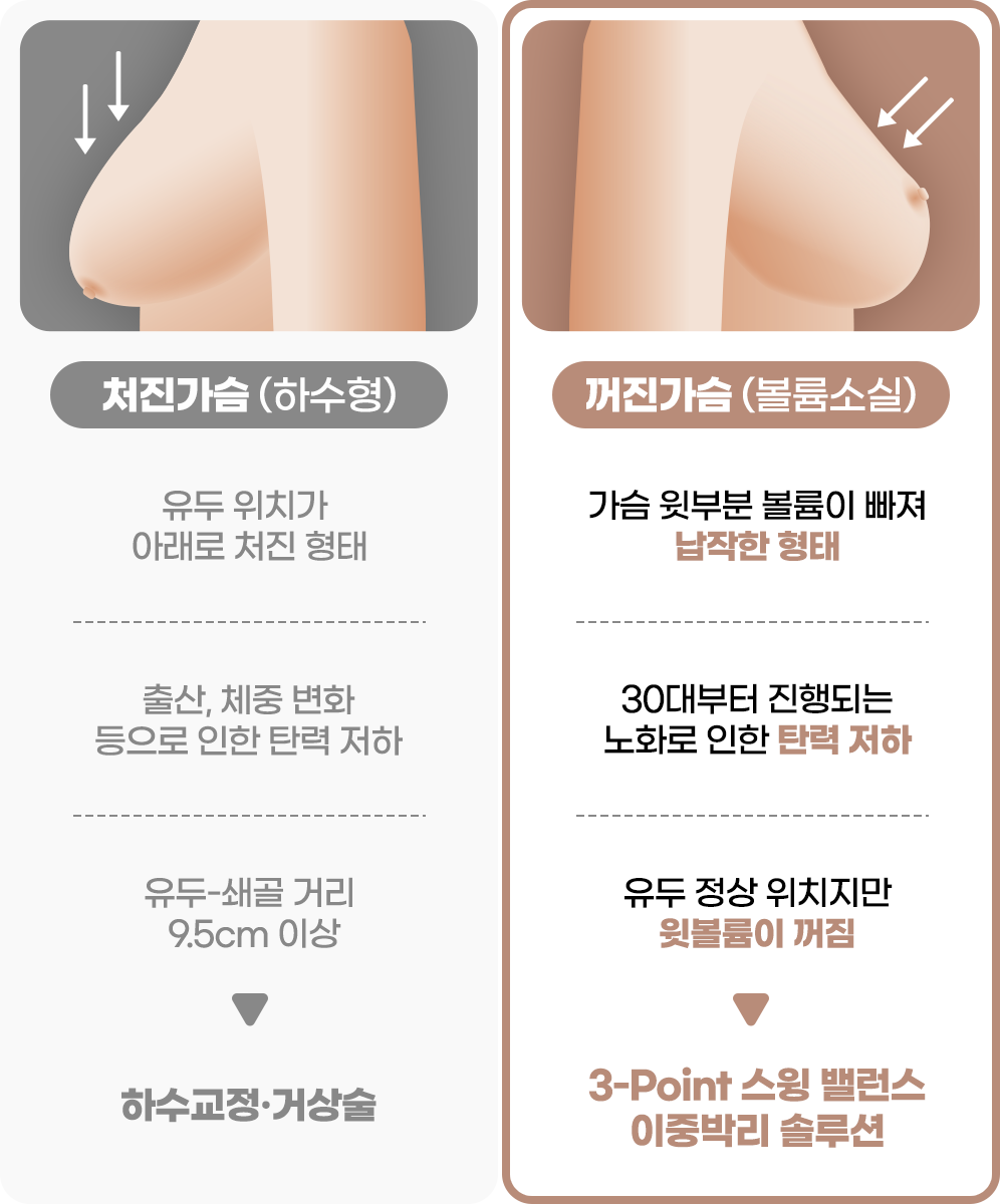 처진가슴 꺼짐가슴 비교