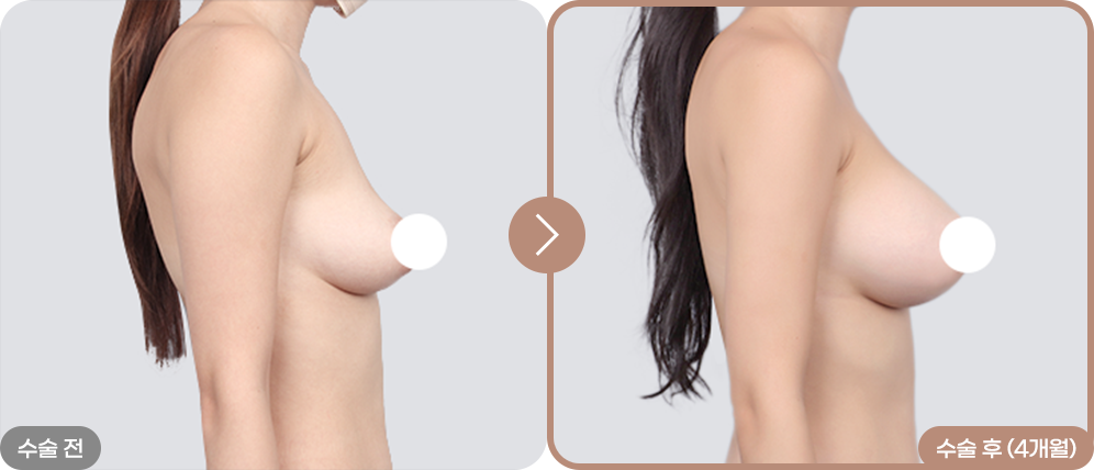 디에이 리프팅 가슴성형