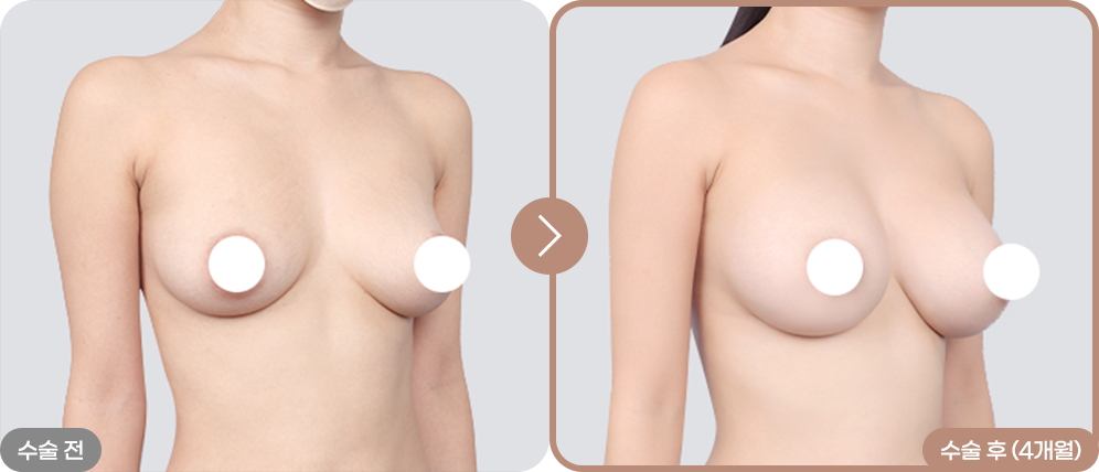 디에이 리프팅 가슴성형