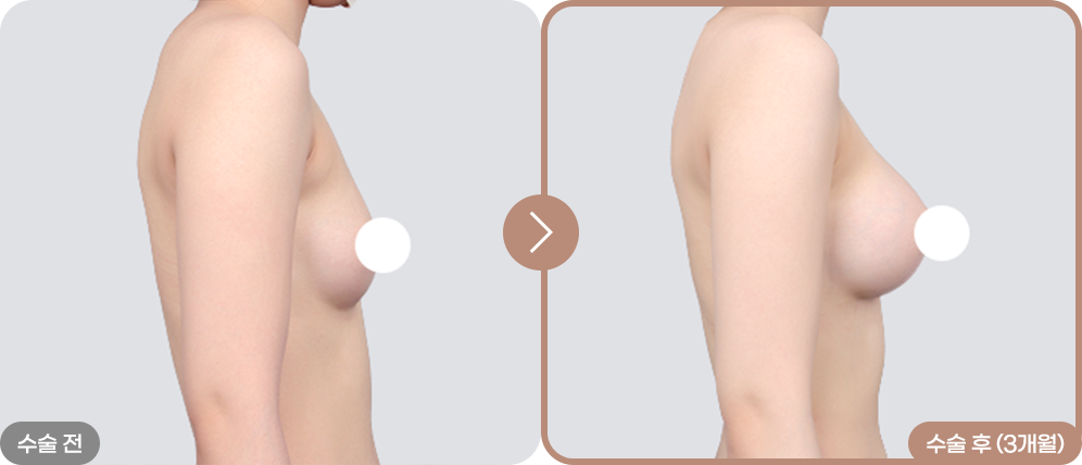 디에이 리프팅 가슴성형