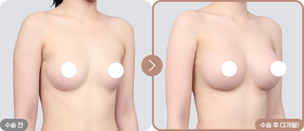 디에이 리프팅 가슴성형