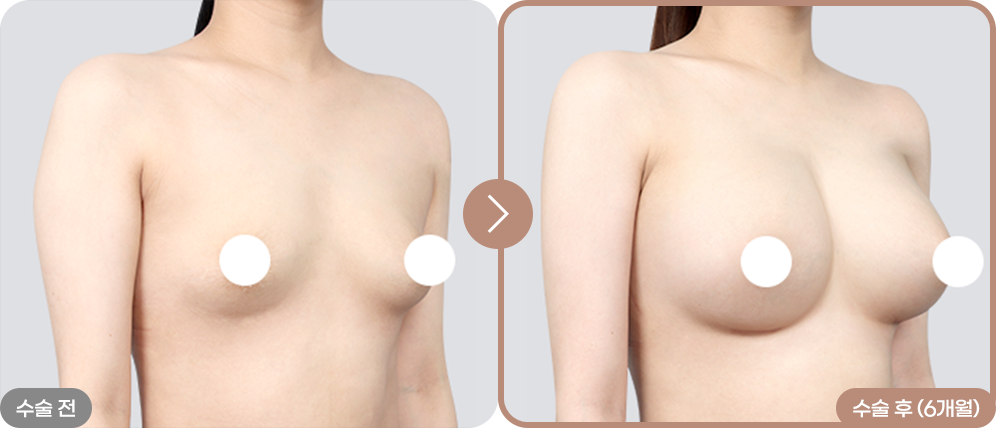 디에이 리프팅 가슴성형
