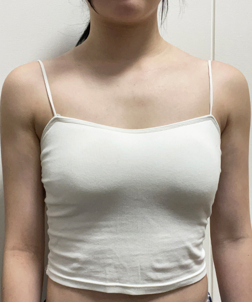 수술 전
