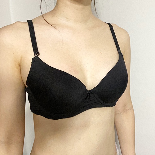 수술 전