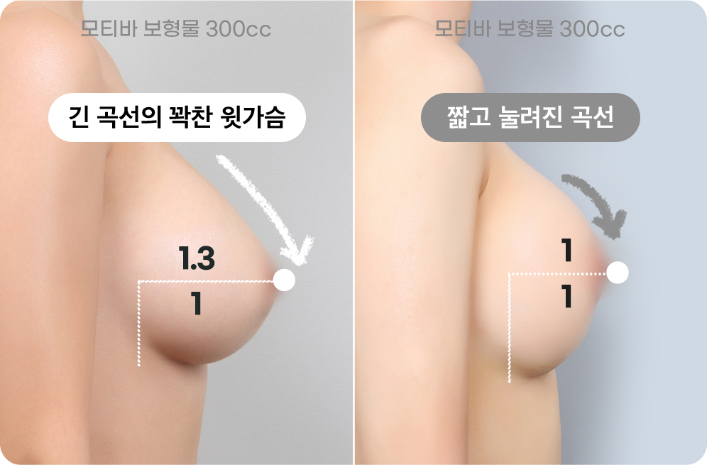 디에이 가슴성형